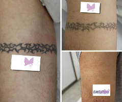 remove arm tattoo with laser