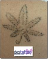 Borrar tatuaje hoja marihuana sesiones