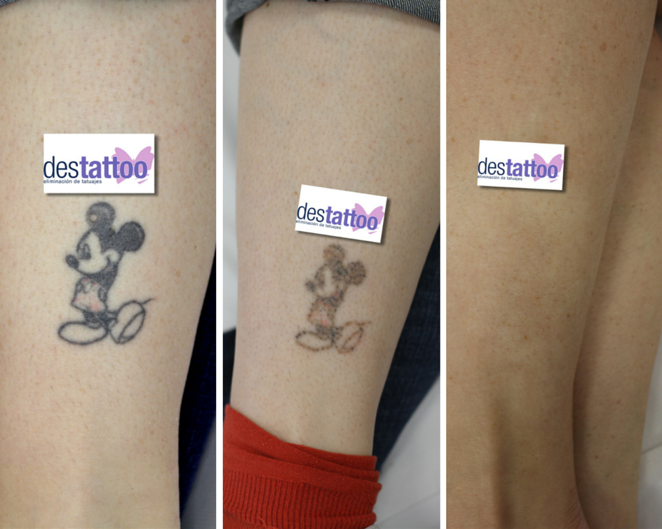 Destattoo - Galería - imágenes de eliminación de tatuajes